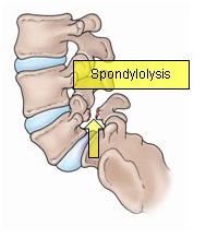 Spondylolysis
