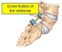 Screw flixation of th vertebrae