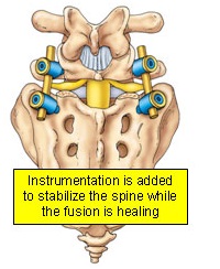 Instrumentation is added to stabilize the spine while the fusion is healing