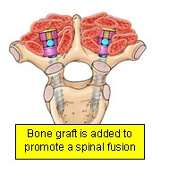 Bone graft is added to promote a spinal fusion