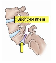 Spondylolysis